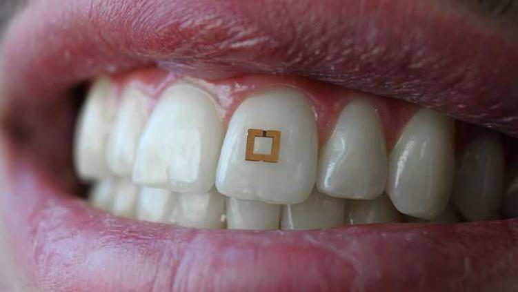 Microchip op tand meet opname suiker, zout en alcohol Microchip op tand meet opname suiker, zout en alcohol
